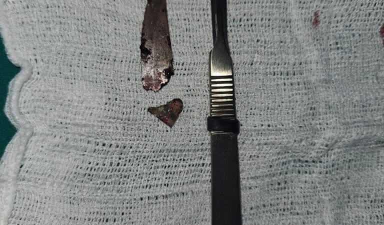 Cirurgia Bucomaxilo do HRCC remove lâmina alojada em rosto de paciente e devolve qualidade de vida após uma década de dores